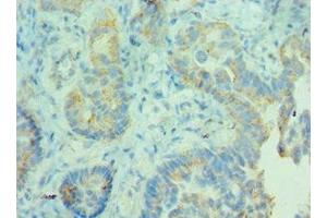 Immunohistochemistry of paraffin-embedded human lung cancer using ABIN7158946 at dilution of 1:100