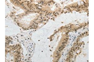 The image on the left is immunohistochemistry of paraffin-embedded Human colon cancer tissue using ABIN7130225(MGEA5 Antibody) at dilution 1/20, on the right is treated with fusion protein. (MGEA5 antibody)