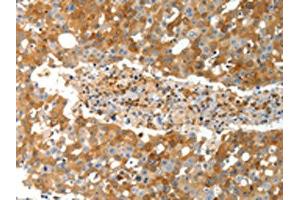The image on the left is immunohistochemistry of paraffin-embedded Human breast cancer tissue using (TEP1 Antibody) at dilution 1/40, on the right is treated with synthetic peptide. (TEP1 antibody)
