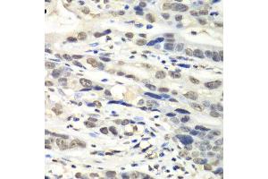 Immunohistochemistry of paraffin-embedded human gastric cancer using NUDT1 antibody. (NUDT1 antibody  (AA 1-179))