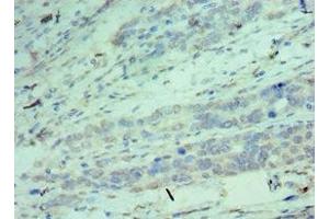 Immunohistochemistry of paraffin-embedded human endometrial cancer using ABIN7148906 at dilution of 1:100 (CDK9 antibody  (AA 153-372))