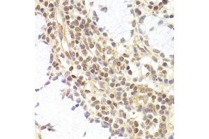Immunohistochemistry of paraffin-embedded human adenomyosis using PHC1 antibody (ABIN5973455) at dilution of 1/200 (40x lens). (PHC1 antibody)