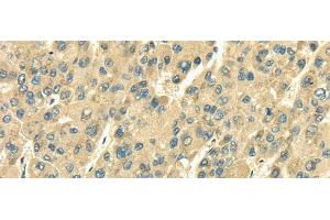 Immunohistochemistry of paraffin-embedded Human liver cancer tissue using SDF4 Polyclonal Antibody at dilution 1:35 (SDF4 antibody)