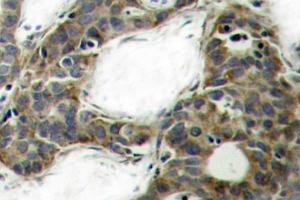 Immunohistochemistry (IHC) analyzes of Catenin-beta antibody in paraffin-embedded human breast carcinoma tissue. (CTNNB1 antibody)