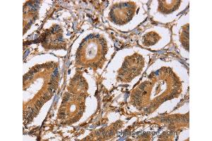 Immunohistochemistry of Human colon cancer using LXN Polyclonal Antibody at dilution of 1:25 (Latexin antibody)
