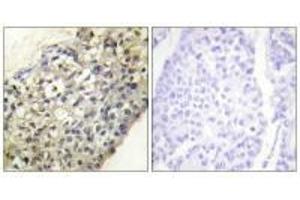Immunohistochemistry analysis of paraffin-embedded human breast carcinoma tissue, using LATH antibody. (BPIFA4P antibody)