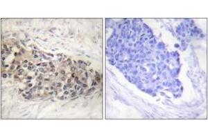 Immunohistochemistry analysis of paraffin-embedded human breast carcinoma tissue, using USF2 Antibody. (USF2 antibody  (AA 196-245))
