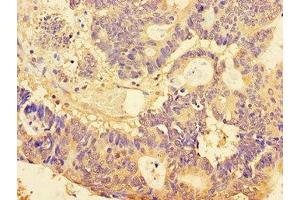 Immunohistochemistry of paraffin-embedded human colon cancer using ABIN7160076 at dilution of 1:100 (BUB3 antibody  (AA 6-217))