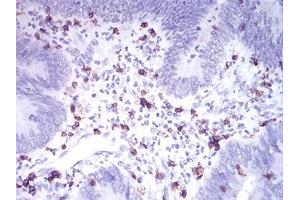 Immunohistochemical analysis of paraffin-embedded rectum cancer tissues using CD2 mouse mAb with DAB staining.