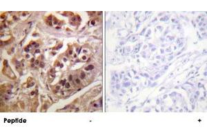 Immunohistochemistry analysis of paraffin-embedded human breast carcinoma tissue using GRLF1 polyclonal antibody . (GRLF1 antibody)