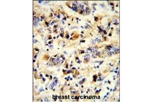 Formalin-fixed and paraffin-embedded human breast carcinoma reacted with EGFR Antibody, which was peroxidase-conjugated to the secondary antibody, followed by DAB staining. (EGFR antibody)