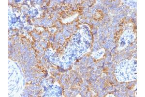 Formalin-fixed, paraffin-embedded human Colon stained with CEA Mouse Monoclonal Antibody (C66/1291). (CEACAM5 antibody)