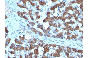Formalin-fixed, paraffin-embedded human Hepatocellular Ca stained with CPS1 Monoclonal Antibody (SPM615).