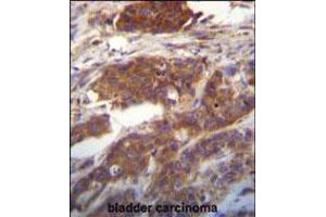 Ufc1 Antibody immunohistochemistry analysis in formalin fixed and paraffin embedded human bladder carcinoma followed by peroxidase conjugation of the secondary antibody and DAB staining. (UFC1 antibody  (C-Term))