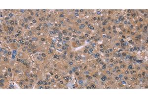 Immunohistochemistry of paraffin-embedded Human liver cancer tissue using GLYR1 Polyclonal Antibody at dilution 1:30 (GLYR1 antibody)