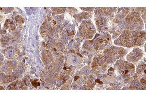 ABIN6273855 at 1/100 staining Human liver cancer tissue by IHC-P. (GPR146 antibody  (Internal Region))
