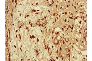 Immunohistochemistry of paraffin-embedded human lung cancer using ABIN7168651 at dilution of 1:100 (SEC14L3 antibody  (AA 201-400))