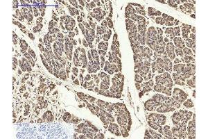 Immunohistochemistry of paraffin-embedded Human stomach cancer tissue using PYCARD Polyclonal Antibody at dilution of 1:200. (PYCARD antibody)
