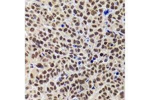 Immunohistochemistry of paraffin-embedded human kidney cancer using PHIP antibody at dilution of 1:100 (40x lens). (PHIP antibody)
