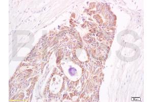 Formalin-fixed and paraffin embedded human colon carcinoma labeled with Anti-CEA Polyclonal Antibody, Unconjugated (ABIN672291) at 1:200 followed by conjugation to the secondary antibody and DAB staining (CEA antibody  (AA 315-365))