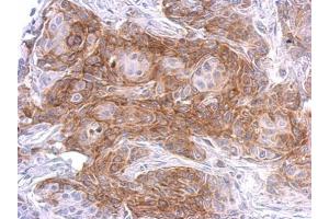 IHC-P Image SIPA1 antibody [C3], C-term detects SIPA1 protein at weak membrane and cytosol on Cal27 xenograft by immunohistochemical analysis. (SIPA1 antibody  (C-Term))