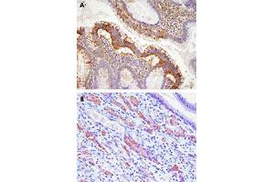 Paraffin embedded sections of human colon (A) and gastric cancer tissue (B) were incubated with EPHA2 monoclonal antibody, clone 3D7  (1:100) for 2 hours at room temperature. (EPH Receptor A2 antibody  (AA 559-976))