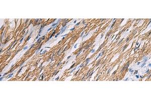 Immunohistochemistry of paraffin-embedded Human gastric cancer tissue using KCNH7 Polyclonal Antibody at dilution of 1:30(x200) (KCNH7 antibody)