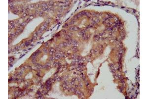 IHC image of ABIN7151045 diluted at 1:500 and staining in paraffin-embedded human endometrial cancer performed on a Leica BondTM system. (KCMF1 antibody  (AA 98-226))