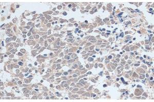 Immunohistochemistry of paraffin-embedded Human lung cancer using ZNF581 Polyclonal Antibody at dilution of 1:100 (40x lens). (ZNF581 antibody)