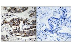 Immunohistochemical analysis of paraffin-embedded human breast carcinoma tissue using Girdin (Phospho-Ser1417) antibody (left)or the same antibody preincubated with blocking peptide (right). (Girdin antibody  (pSer417))