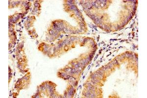 IHC image of ABIN7170472 diluted at 1:200 and staining in paraffin-embedded human endometrial cancer performed on a Leica BondTM system. (SPA17 antibody  (AA 1-146))