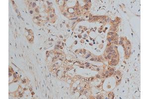 ABIN6266511 at 1/50 staining human colon cancer tissue sections by IHC-P.