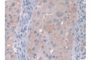 Detection of GAMT in Human Breast cancer Tissue using Polyclonal Antibody to Guanidinoacetate-N-Methyltransferase (GAMT) (GAMT antibody  (AA 64-236))