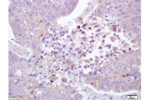 Formalin-fixed and paraffin embedded human lung carcinoma labeled with Anti-phospho-ROCK1(Thr455/Ser456) Polyclonal Antibody, Unconjugated  at 1:200 followed by conjugation to the secondary antibody and DAB staining.