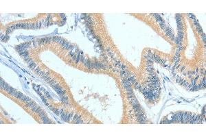 Immunohistochemistry of paraffin-embedded Human colon cancer using ASGR1 Polyclonal Antibody at dilution of 1:50 (Asialoglycoprotein Receptor 1 antibody)