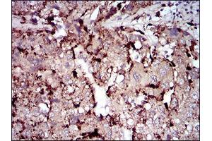Immunohistochemical analysis of paraffin-embedded liver cancer tissues using PLA2G12A mouse mAb with DAB staining.