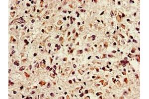 Immunohistochemistry of paraffin-embedded human glioma using ABIN7151635 at dilution of 1:100 (Nth Endonuclease III-Like 1 (NTHL1) (AA 31-312) antibody)
