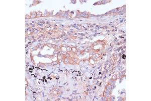 Immunohistochemistry of paraffin-embedded human lung cancer using RPL32 antibody (ABIN6129104, ABIN6147138, ABIN6147139 and ABIN6216824) at dilution of 1:100 (40x lens). (RPL32 antibody  (AA 1-135))