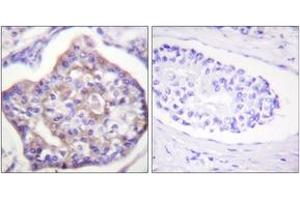 Immunohistochemistry analysis of paraffin-embedded human breast carcinoma, using Vinculin (Phospho-Tyr821) Antibody. (Vinculin antibody  (pTyr821))