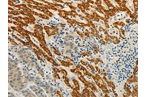 The image on the left is immunohistochemistry of paraffin-embedded Human liver cancer tissue using ABIN7190314(CMTM7 Antibody) at dilution 1/30, on the right is treated with synthetic peptide. (CMTM7 antibody)