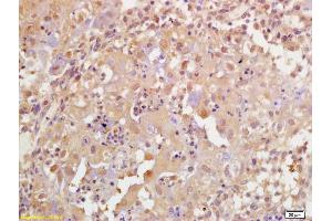 Formalin-fixed and paraffin embedded human breast carcinoma labeled with Rabbit Anti Phospho-BRCA1(Ser1189) Polyclonal Antibody, Unconjugated (ABIN756637) at 1:200 followed by conjugation to the secondary antibody and DAB staining (BRCA1 antibody  (pSer1189))