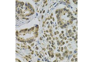 Immunohistochemistry of paraffin-embedded human breast cancer using EBAG9 Antibody. (RCAS1 antibody  (AA 28-213))