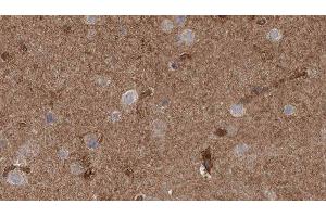 ABIN6277796 at 1/100 staining Human brain cancer tissue by IHC-P. (CLCN3 antibody  (N-Term))