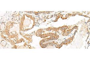 Immunohistochemistry of paraffin-embedded Human thyroid cancer tissue using HEBP1 Polyclonal Antibody at dilution of 1:60(x200)