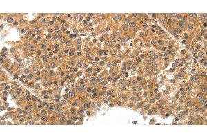 Immunohistochemistry of paraffin-embedded Human liver cancer tissue using TEK Polyclonal Antibody at dilution 1:50 (TEK antibody)