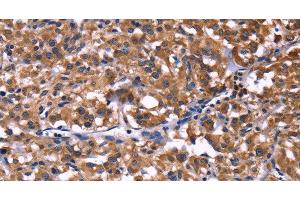 Immunohistochemistry of paraffin-embedded Human thyroid cancer tissue using SELPLG Polyclonal Antibody at dilution 1:50 (SELPLG antibody)