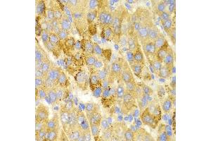 Immunohistochemistry of paraffin-embedded human liver cancer using LAMP3 antibody (ABIN5971497) at dilution of 1/100 (40x lens). (LAMP3 antibody)