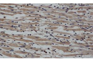 Immunohistochemistry of paraffin-embedded Human gasrtic cancer tissue using NOS2 Polyclonal Antibody at dilution 1:40 (NOS2 antibody)