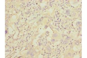 Immunohistochemistry of paraffin-embedded human liver cancer using ABIN7154068 at dilution of 1:100 (GGTLC2 antibody  (AA 1-218))