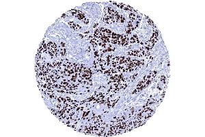 Esophageal squamous cell carcinoma with intense p63 immunostaining of tumor cells (Recombinant TCP1 alpha/CCTA antibody  (AA 600-680))